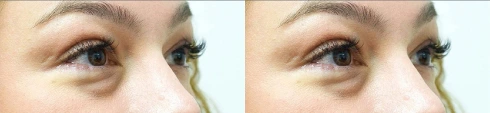 Female eyes, before and after Blepharoplasty treatment, oblique view, patient 1