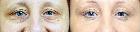 Female eyes, before and after Blepharoplasty treatment, front view, patient 2