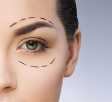Female eyelid before Blepharoplasty treatment
