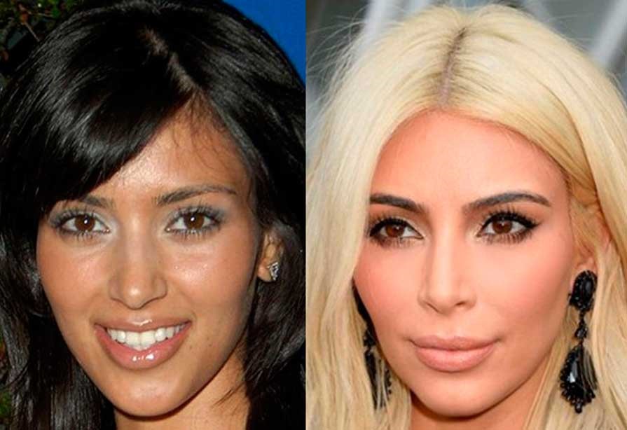 Kim Kardashian’s nose before and after rhinoplasty, front view