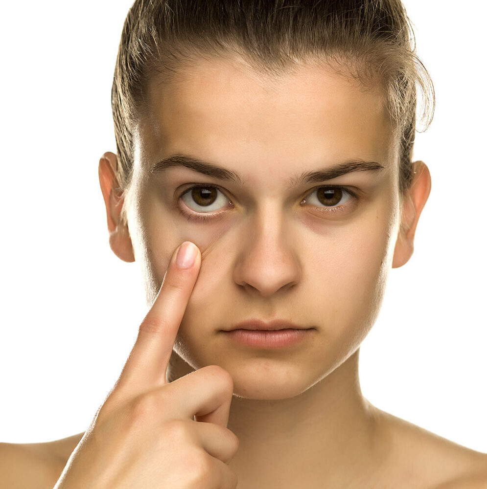 Revision Blepharoplasty - female model