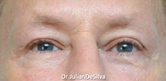 Male eyes, After Blepharoplasty Treatment, front view, patient 1