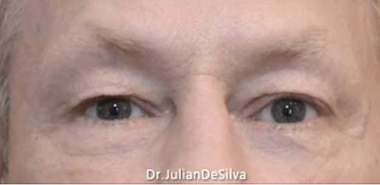 Male eyes, Before Blepharoplasty Treatment, front view, patient 1