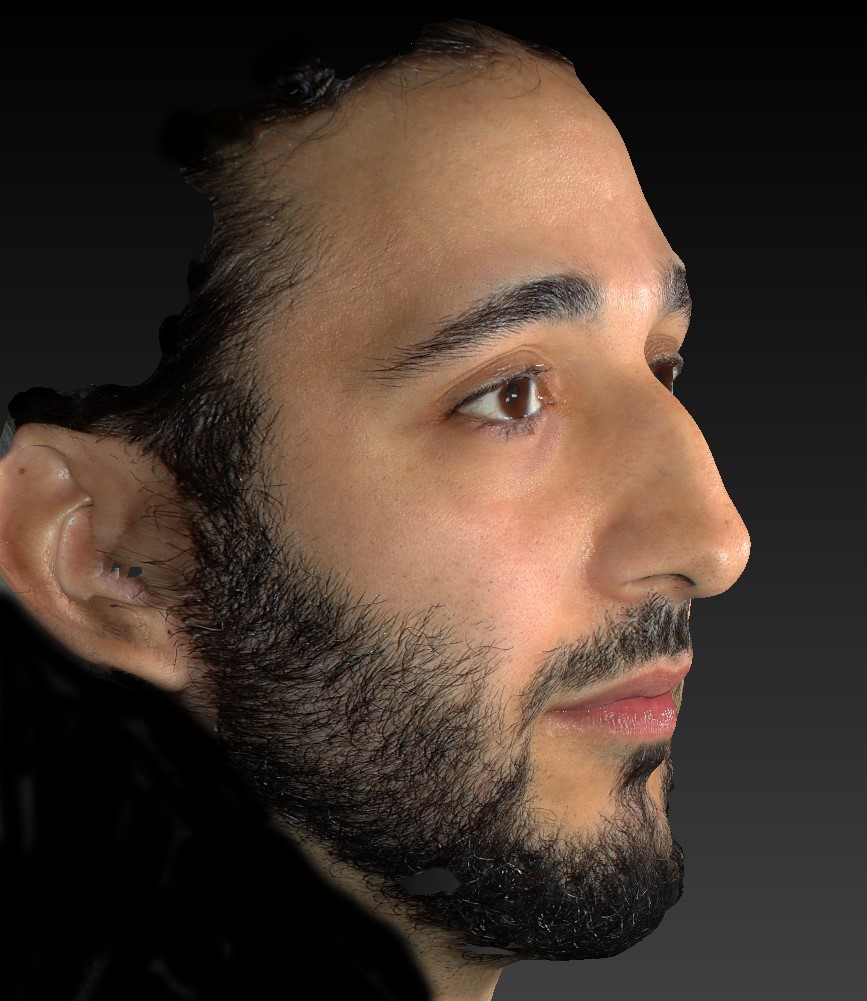 3D-model male face, rhinoplasty procedure, right side view
