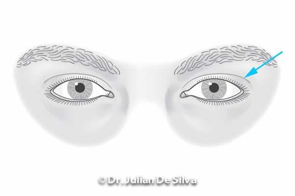 Area around eyes: Male Blepharoplasty (before treatment)
