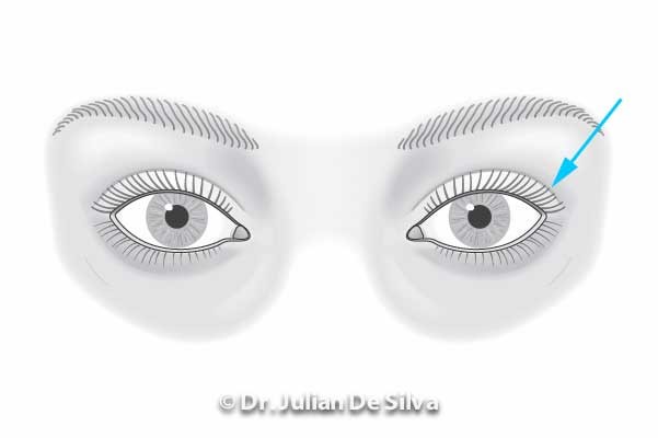 Area around eyes: Male Blepharoplasty (after treatment)