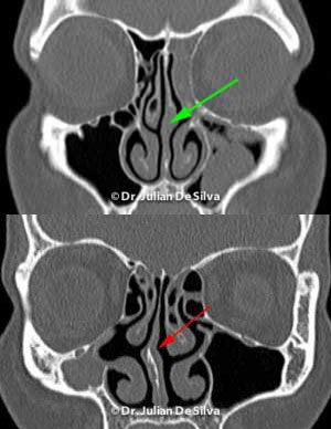 Rhinoplasty Technique (A.K.A. Nose job) - x ray
