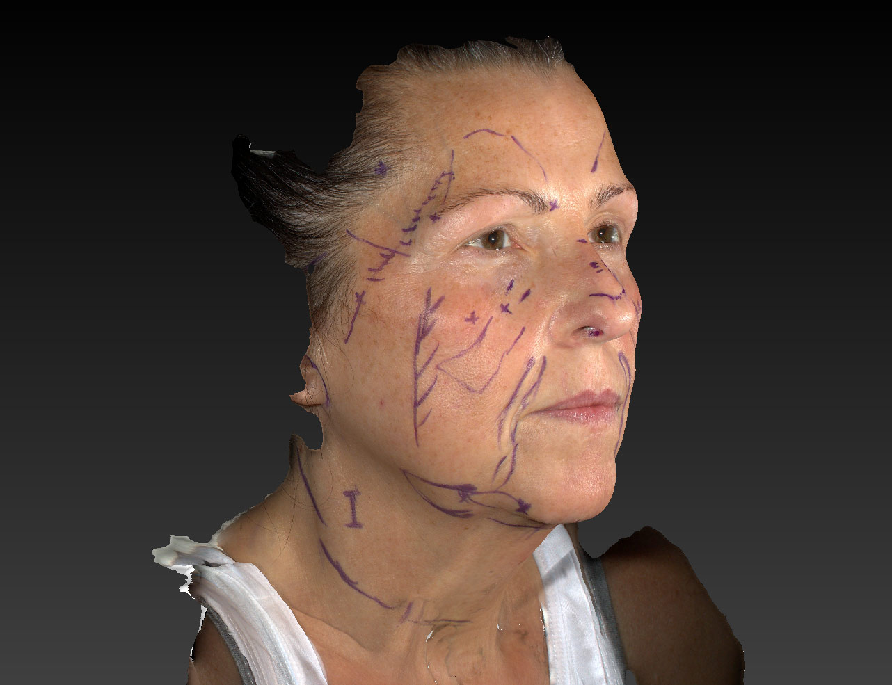 3D Photo. Woman's face, Markings PreOp SanDal