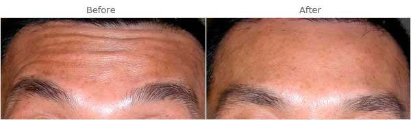Facial aging: Forehead wrinkles, before and after treatment, front view, patient 1