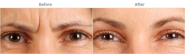 Facial aging: Glabellar wrinkles, before and after treatment, front view, patient 2