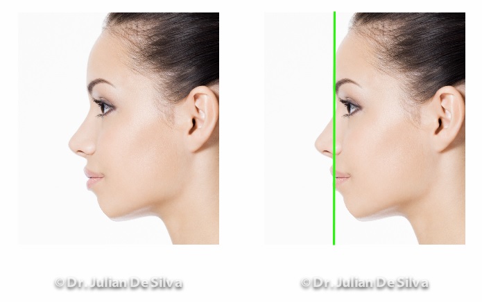 Woman's face, before and after Chin Implant treatment, female patient, left side view