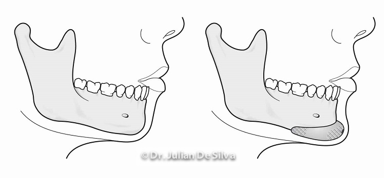 Anatomy: Chin Implants
