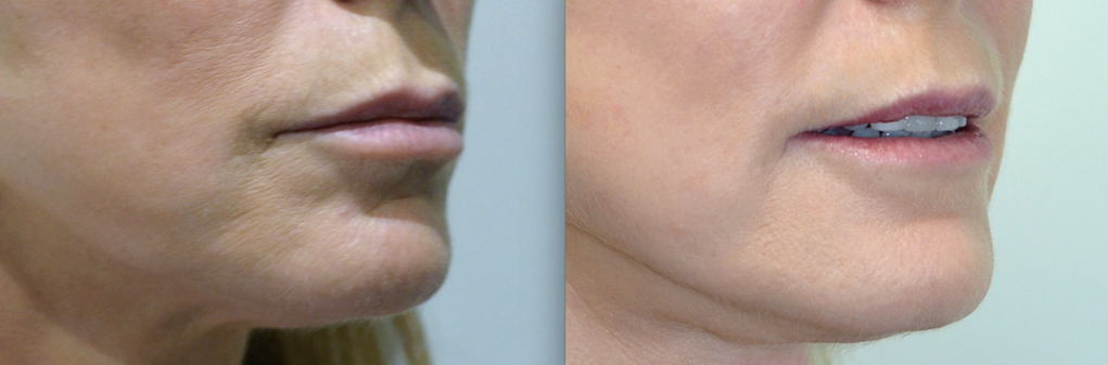 Woman's face: Before and after Laser Resurfacing Treatment - chin, oblique view