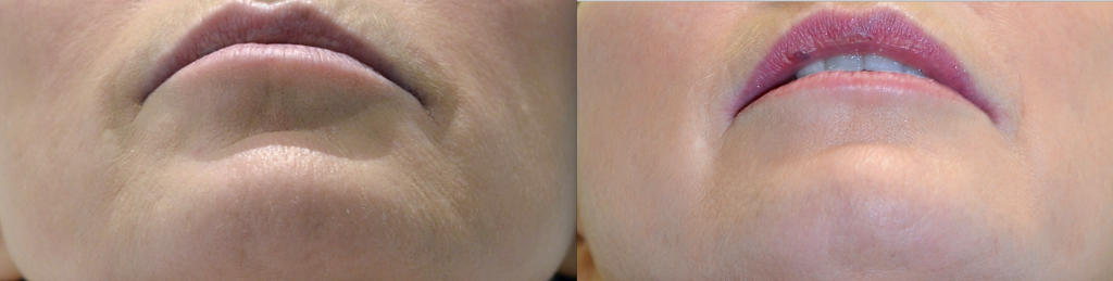 Woman's face: Before and after Laser Resurfacing Treatment - chin, front view