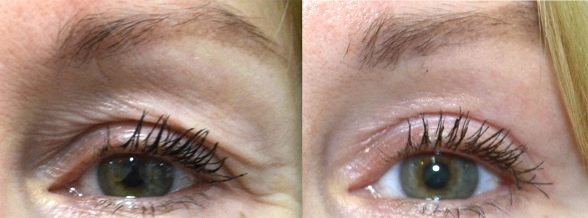 Woman's face: Before and after Laser Resurfacing Treatment - eyelids, front view