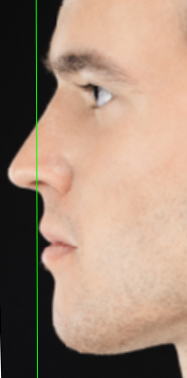 Male face, Lip Reduction (Cheiloplasty) - left side view