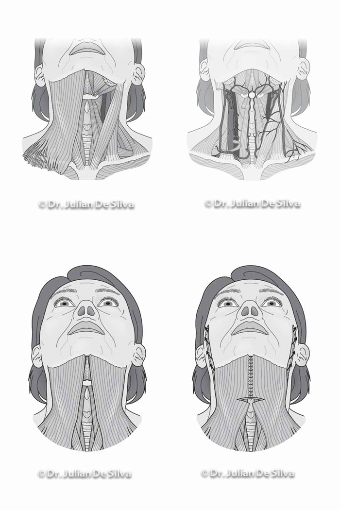 Woman's neck (Necklift diagrams)
