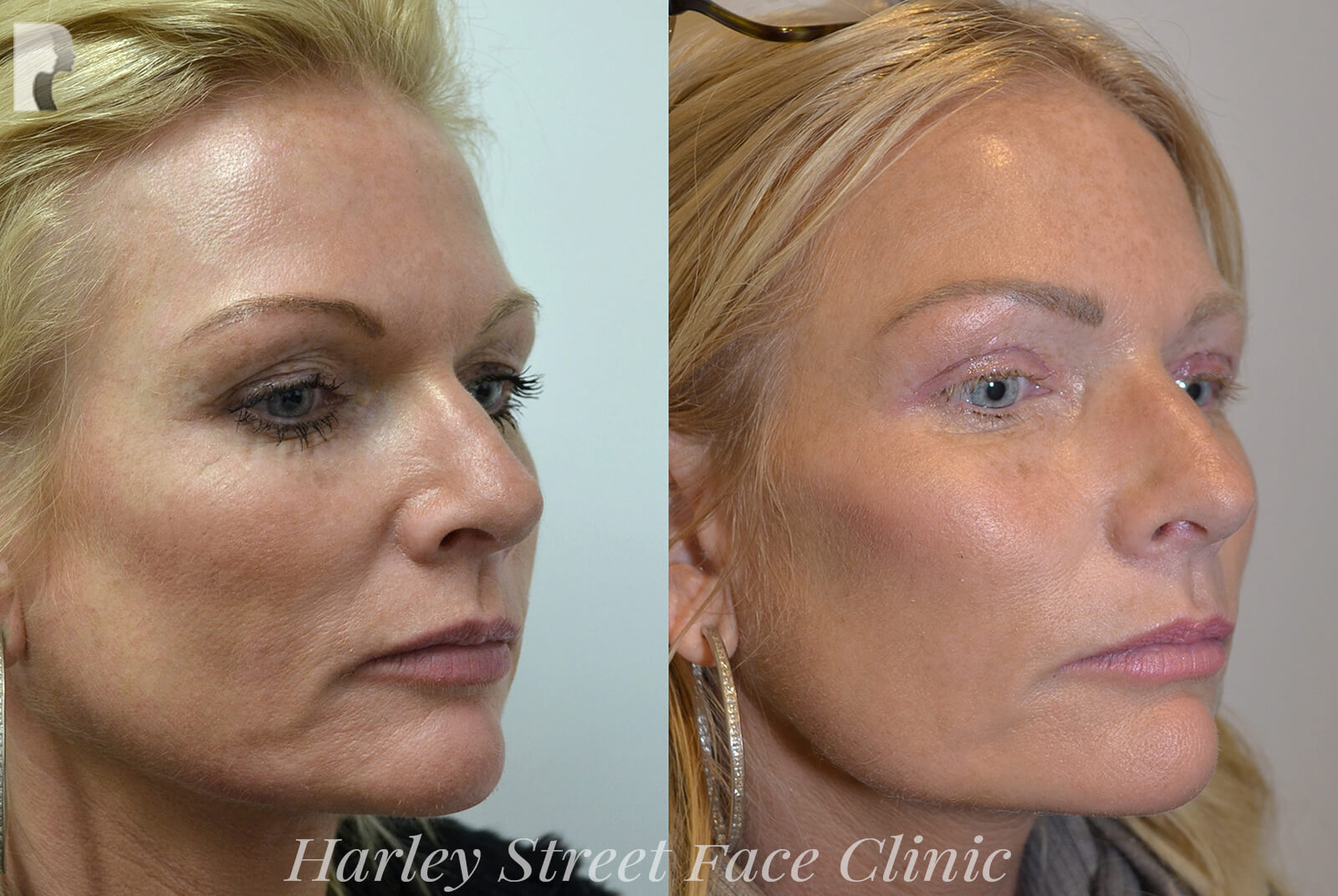 Minimally invasive or non-invasive procedures - female face, before and after treatment