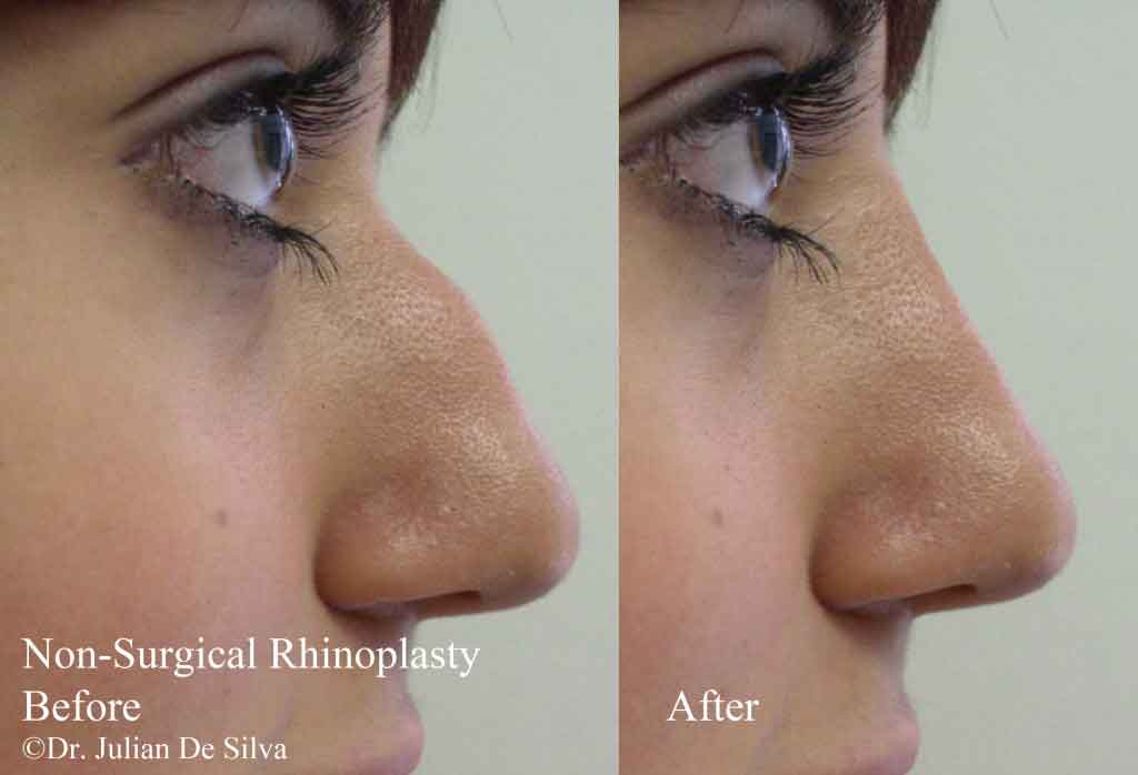 Woman's face, Before and After Non-Surgical Rhinoplasty Treatment, right side view, patient 1