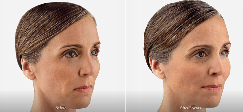 Woman's Face, Before and After 2 years, Dermal Fillers - Voluma, oblique view, female patient 1