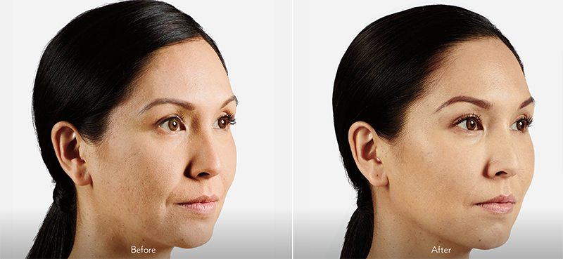 Woman's Face, Before and After Treatment, Dermal Fillers - Voluma, oblique view, female patient 2