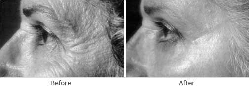 Retinoic: Alpha-lipoic acid (ALA) - before and after photos
