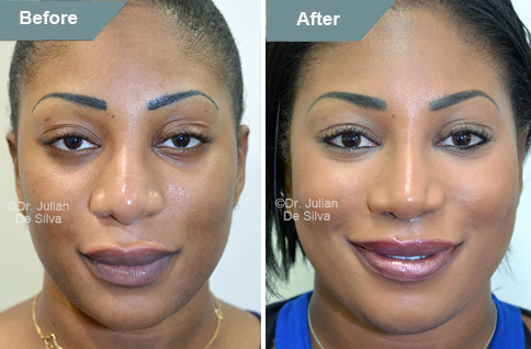 Woman's face, Before and After Lip Lift Treatment, front view