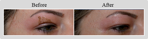 View Photos: Non-Surgical Blepharoplasty