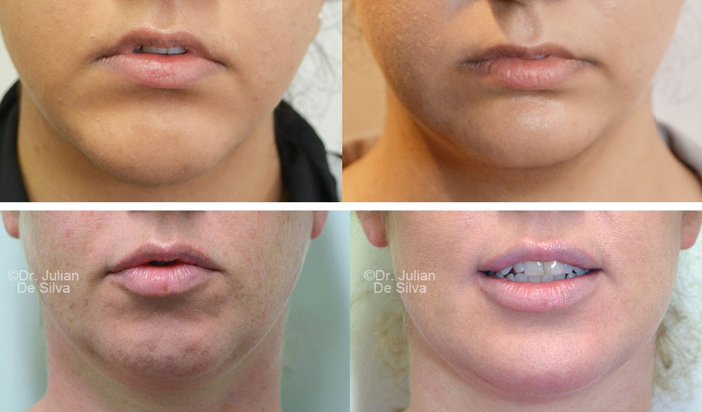 Woman's face, before and after Chin Implants treatment, front view, female patient 2