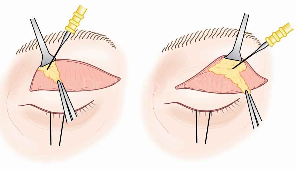 blepharoplasty, surgery techniques
