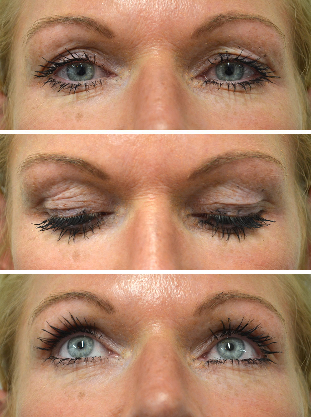 For Eyelids Virtual Consultation - 3 photos: open eyes / closed eyes / eyes look down