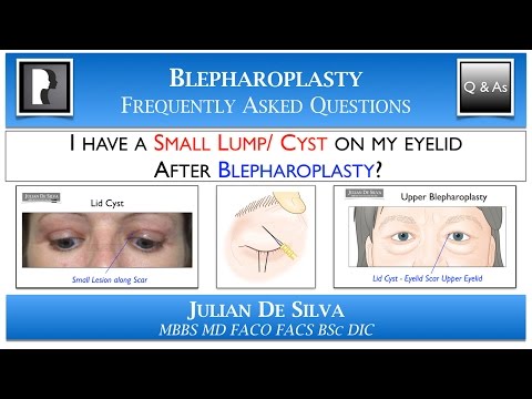 Watch Video: Why does an Eyelid Lump or Cyst occur after Blepharoplasty? How can an eyelid cyst be treated?