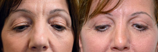 Woman's face Before and After Upper Blepharoplasty Scar at 6weeks, front view, patient 1