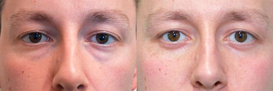 Male face Before and After Lower Blepharoplasty Scar at 6weeks, front view, patient 2