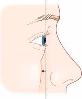 Upper and lower eyelids is usually seen as one of the characteristics of an ageing face - pictures schem