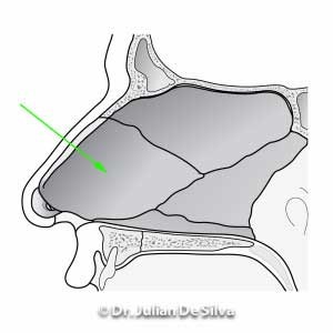 Allergic changes in the nose