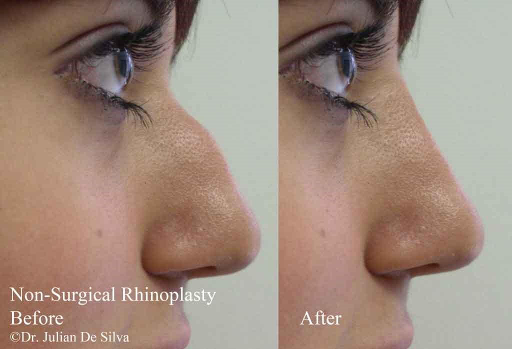 Woman's face, before and after non-surgical rhinoplasty treatment, right side view