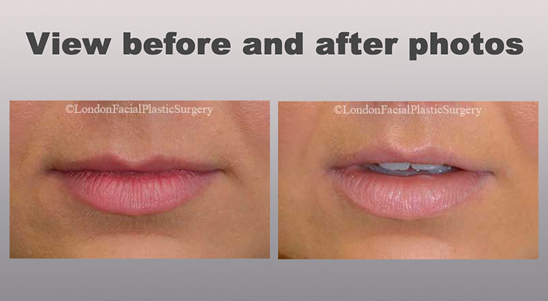 View Lips Before and After Photos