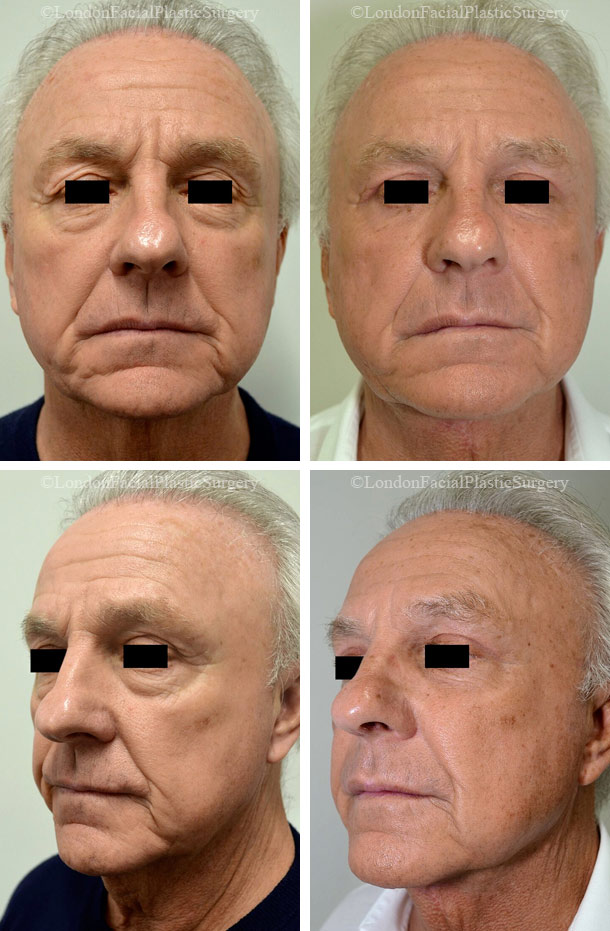 Male face, Before and After Facelift & Neck Lift Treatment, front and left side oblique view, patient 1