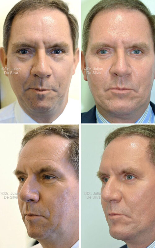 Male face, Before and After Facelift & Neck Lift Treatment, front and left side oblique view, patient 2
