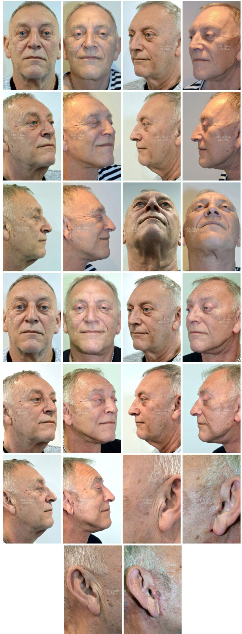 Watch Gallery Photos: Male Facelift & Neck Lift