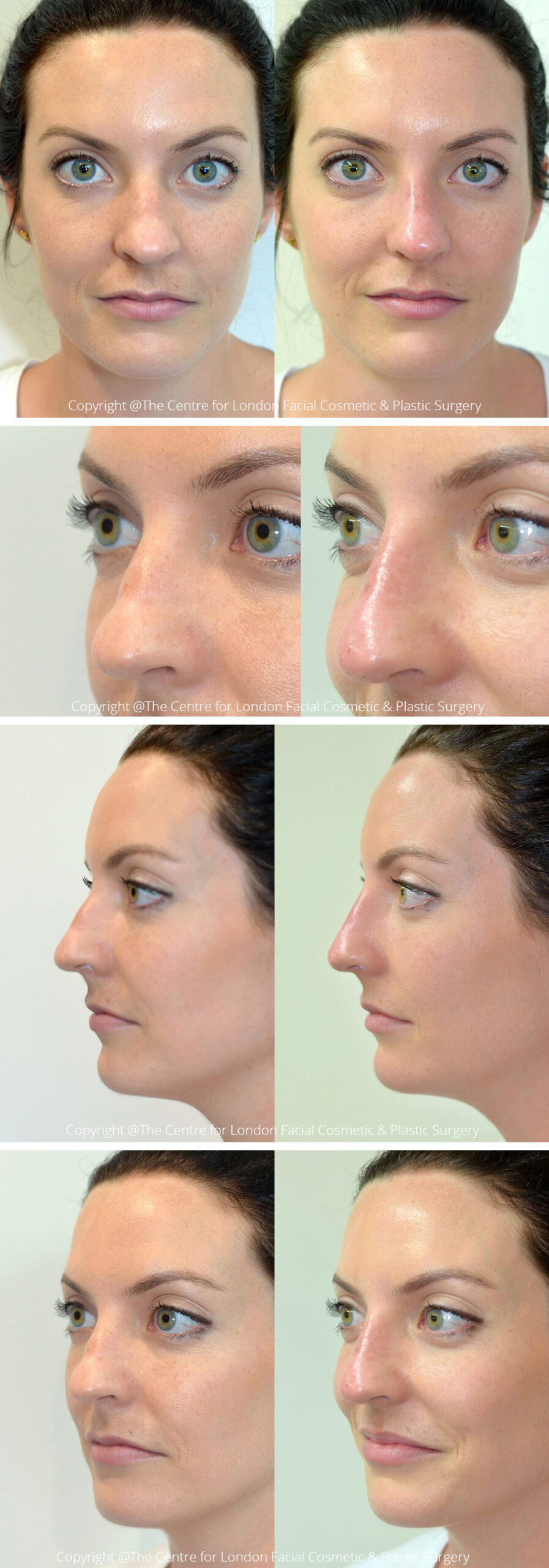 Woman's face, Before and After Non-Surgical Rhinoplasty Treatment, front, left side and oblique view, patient 2
