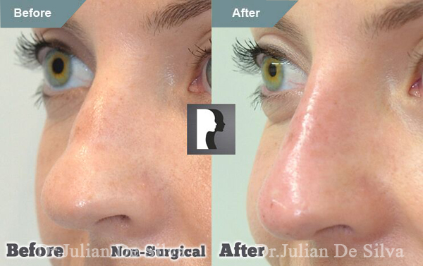 Woman's face, Before and After Non-Surgical Rhinoplasty Treatment, left side oblique view, patient 3