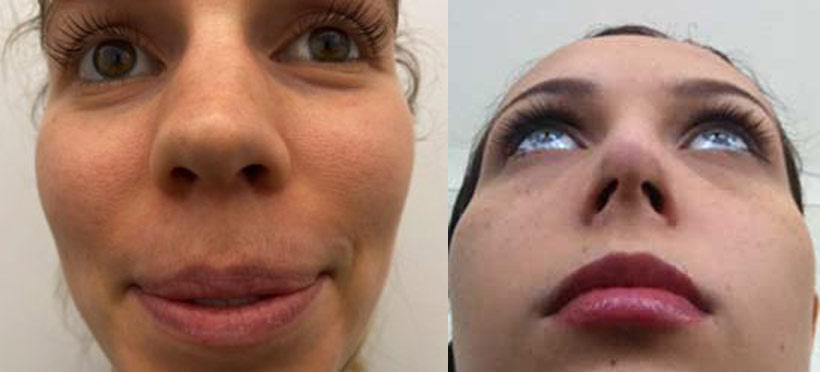 For rhinoplasty Virtual Consultation - 2 photos: face (front view) / face (below view)