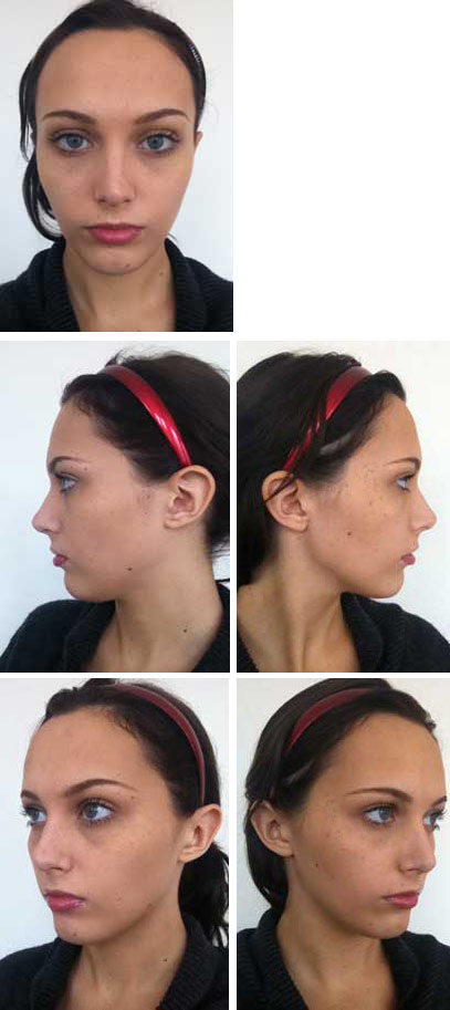 For Virtual Consultation - 5 photos: face (front view / left side view / right side view / left side oblique view / right side oblique view)