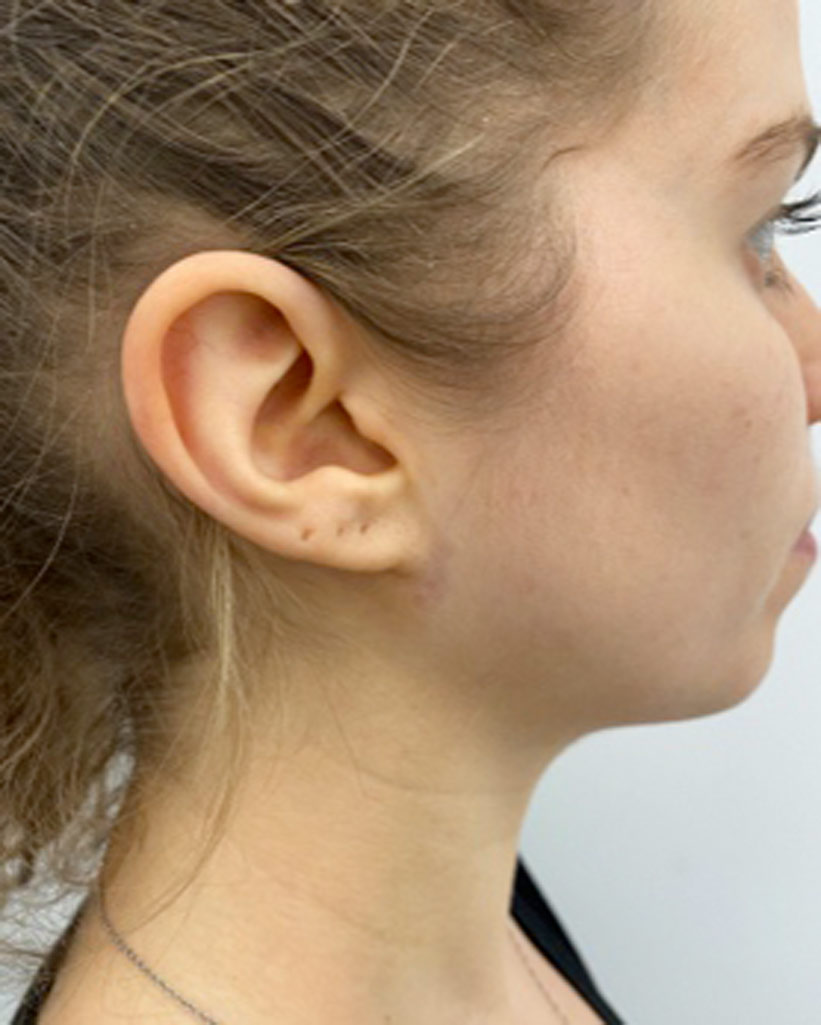 For face and neck lift Virtual Consultation - 1 photo: face or neck (side oblique view)