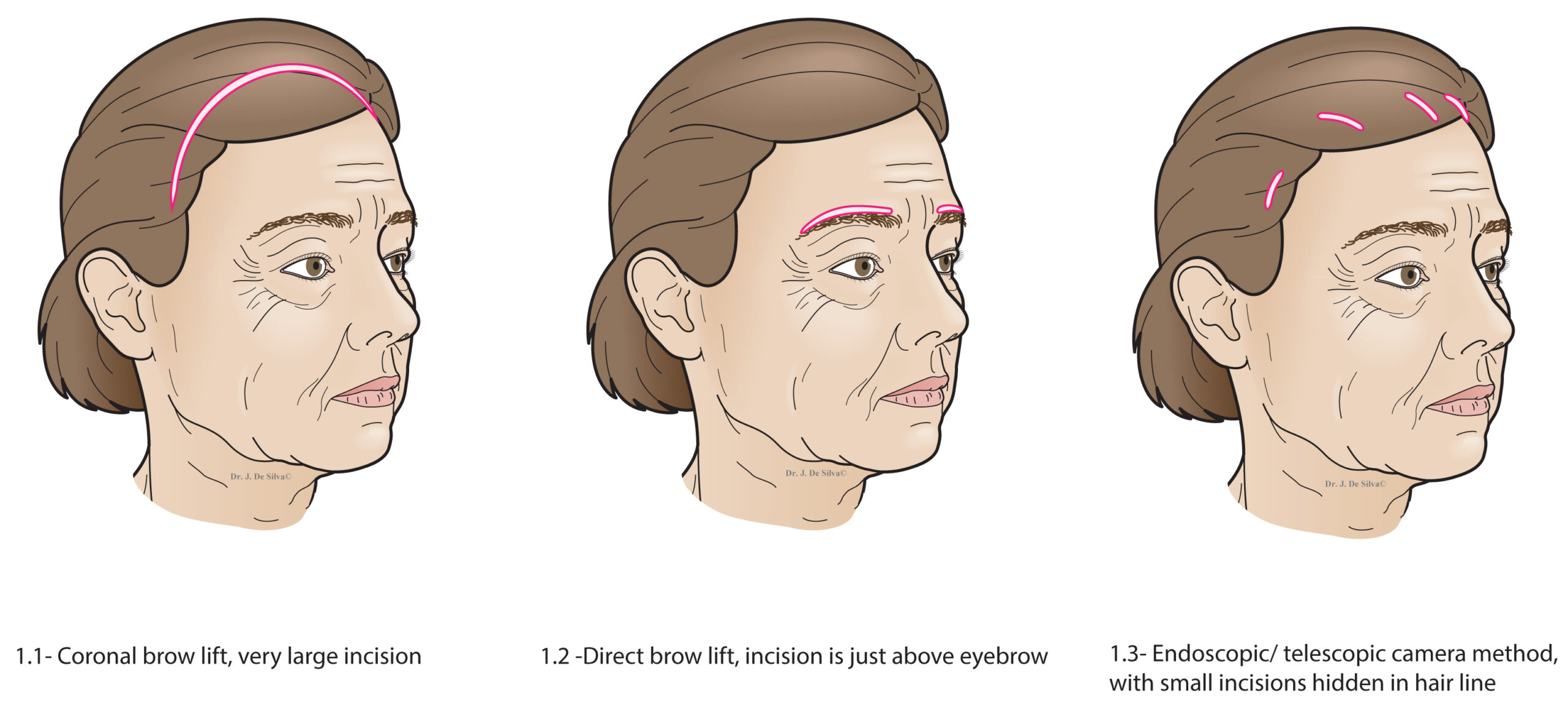 Brow-lift Figures Coronal Direct Endoscopic scaled