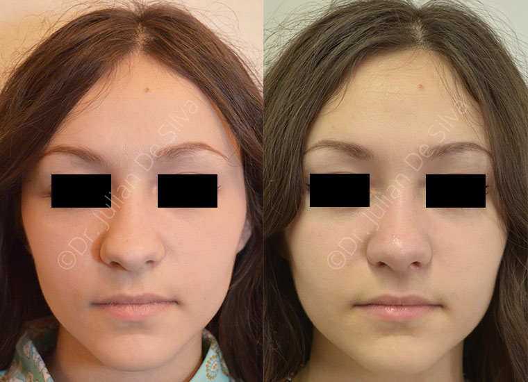 Female face, before and after Rhinoplasty treatment, front view, patient 1