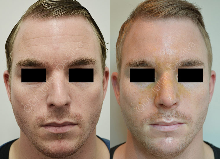Male face, before and after Rhinoplasty treatment, front view, patient 2