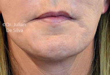 Skin & Laser Resurfacing Before 10